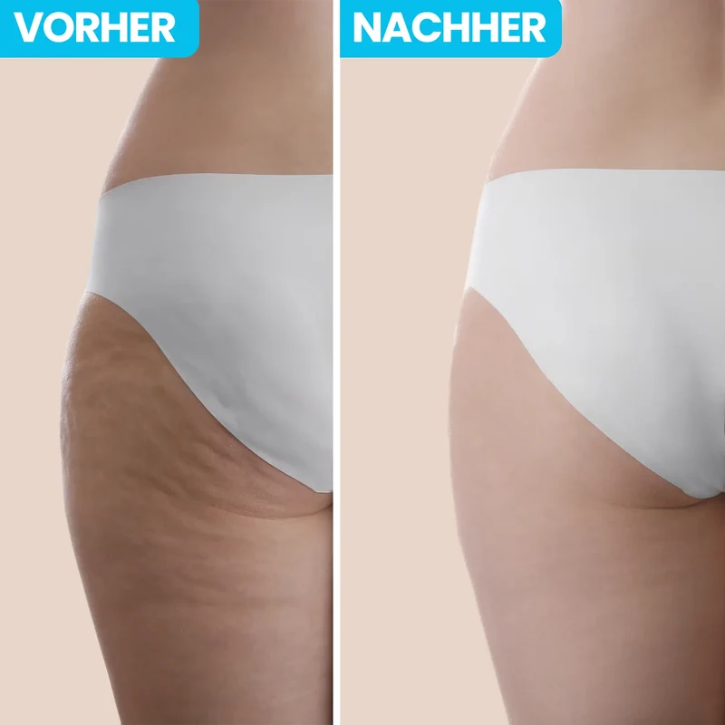 CelluSlim™ | Infrarot-Massagegerät für Cellulite & Fett